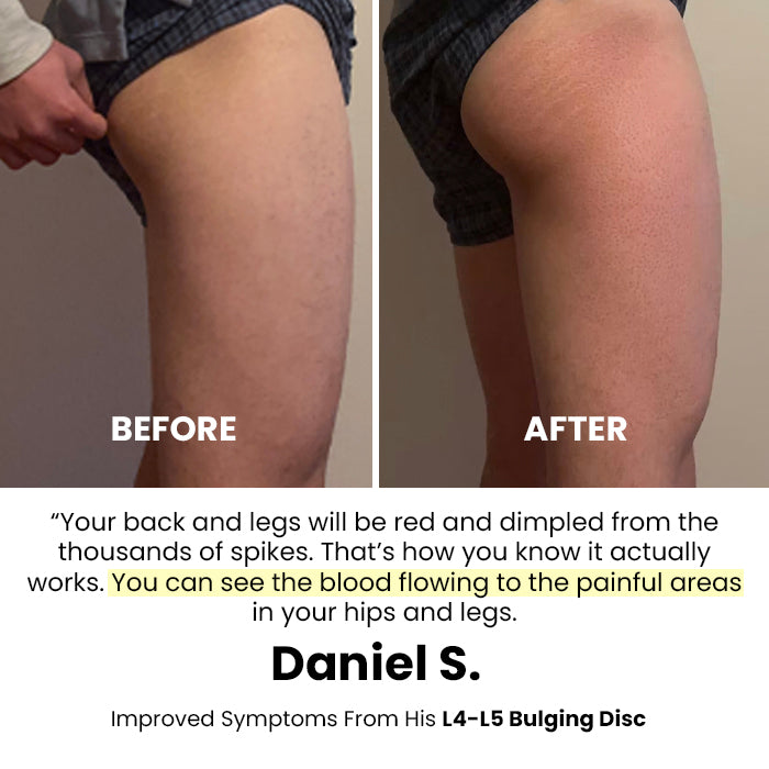 KenRelief Acupressure Set